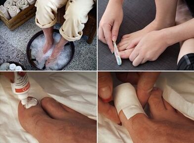 Βράσιμο στον ατμό των ποδιών και εφαρμογή κρέμας ουρίας στα νύχια που έχουν προσβληθεί από μύκητες