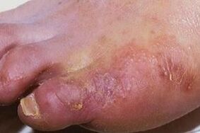 εκδηλώσεις μυκητιασικής λοίμωξης στο δέρμα των ποδιών