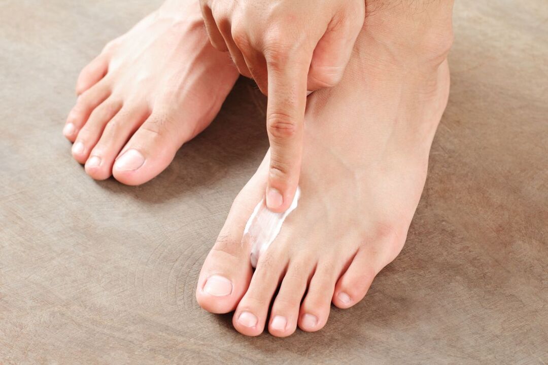 θεραπεία του μύκητα στα πόδια με αλοιφή