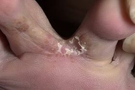 μύκητας του δέρματος ανάμεσα στα δάχτυλα των ποδιών