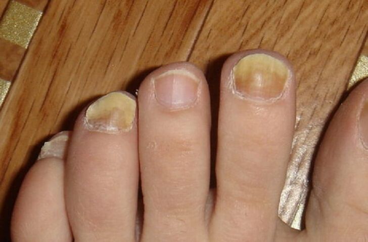 συμπτώματα μύκητα στα νύχια και το δέρμα των ποδιών